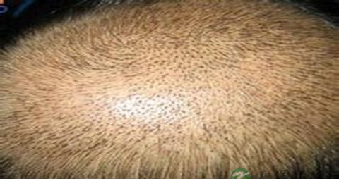 如何制止脱发 如何制止脱发