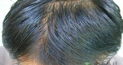 遗传脱发原因