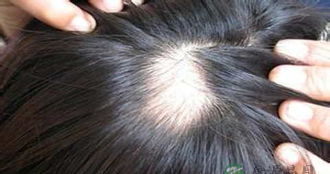 治疗头顶脱发的方法