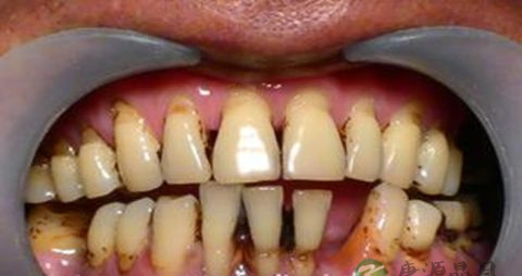 牙龈萎缩要吃什么