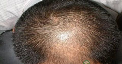 雄性激素性脱发治疗