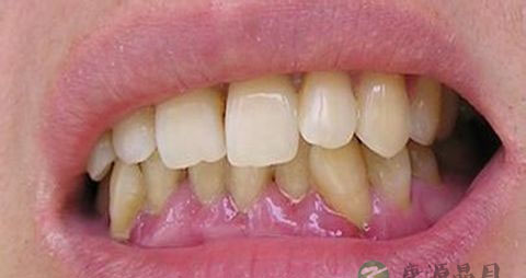 牙龈肿吃什么好