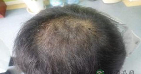 如何治疗头顶脱发