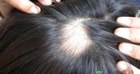 怎么治疗脱发和掉发