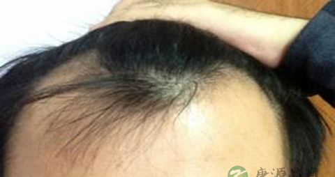 脱发秃顶怎么办 脱发秃顶怎么办