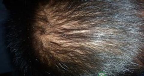 中医治疗脱发有效果吗 中医治疗脱发有效果吗