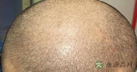 怎么治脂溢性脱发