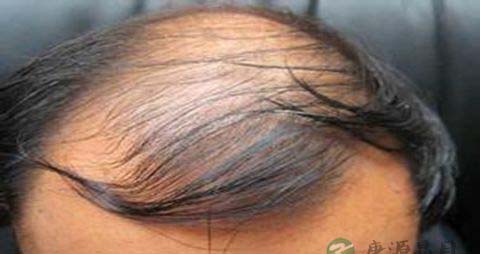 遗传性脱发怎么治 遗传性脱发怎么治