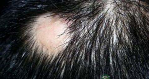 头上脱发怎么办 头上脱发怎么办