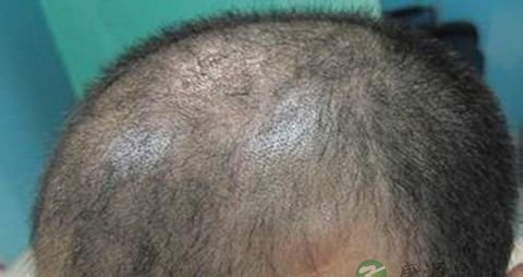 油脂性脱发怎么治 油脂性脱发怎么治