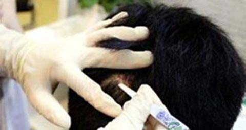 男人脂溢性脱发怎么办 男人脂溢性脱发怎么办