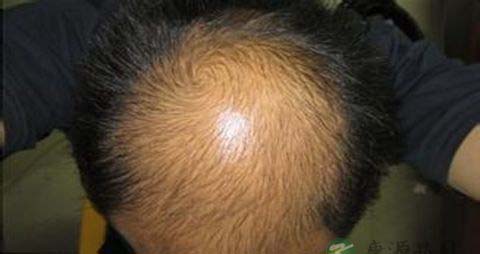 中医治疗脱发方法