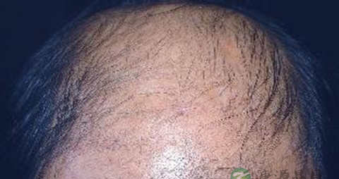 脂溢性脱发有哪些症状 脂溢性脱发有哪些症状