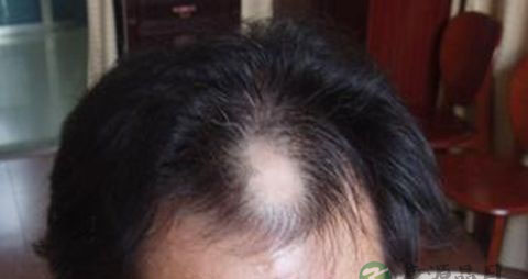 脱发是怎样引起的 脱发是怎样引起的