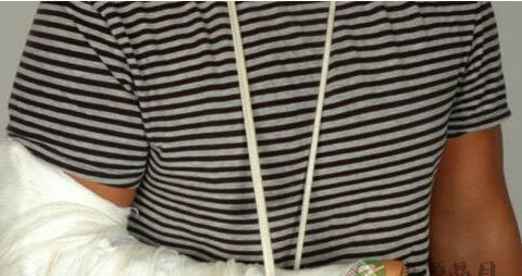 骨折病人吃什么营养品