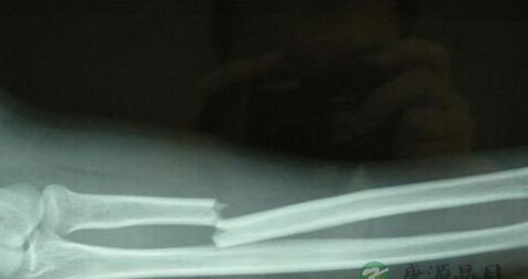 骨折病人吃什么营养品