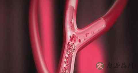 静脉血栓吃什么食物好