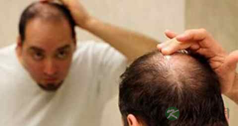 男人为什么会脱发 男人为什么会脱发