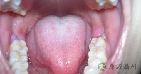 牙龈肿痛 吃什么 牙龈肿痛 吃什么