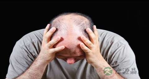 父亲脱发儿子一定脱发吗 父亲脱发儿子一定脱发吗