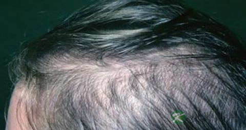 遗传性脱发症状 遗传性脱发症状