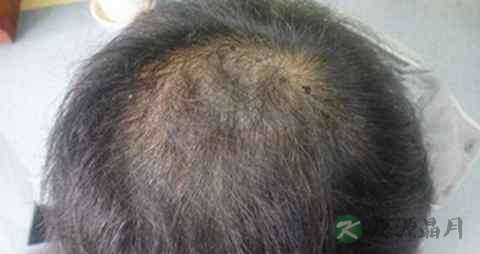 脱发是显性遗传吗 脱发是显性遗传吗