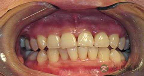 牙龈萎缩要吃什么