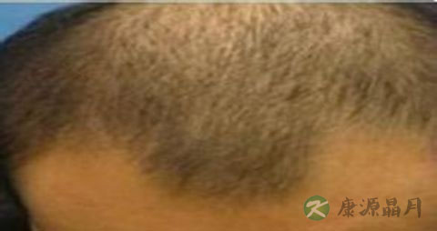 油脂性脱发怎么治 油脂性脱发怎么治