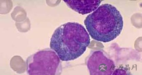 骨髓增生异常综合征饮食注意 骨髓增生异常综合征饮食注意