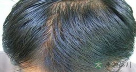 遗传脱发有救吗 遗传脱发有救吗