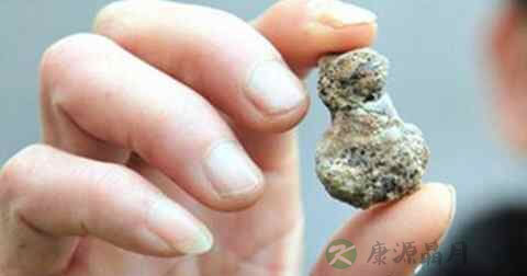 肾结石怎么排出