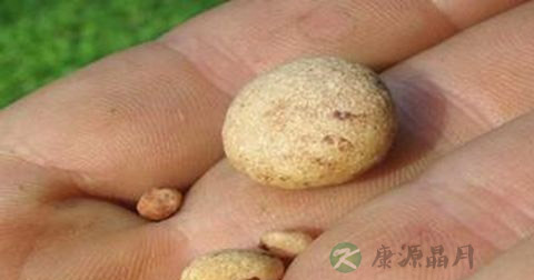 治疗肾结石需要多久