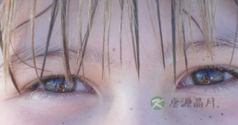 肝脏不好眼角发黑怎么办