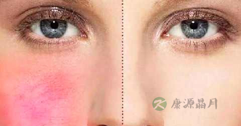 红血丝可以用珍珠粉吗
