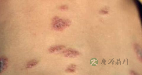 松花粉能治湿疹吗