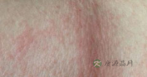 松花粉能治湿疹吗