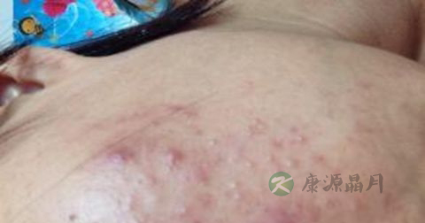 松花粉能治痘痘吗