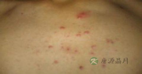 松花粉能治痘痘吗