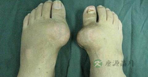 痛风可以吃当归吗