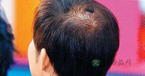 中年男人头发稀疏怎么办
