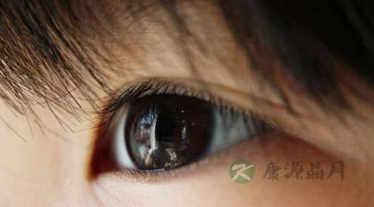 青光眼的早期症状