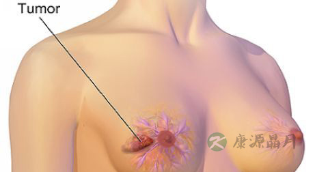 乳腺癌是怎么引起的