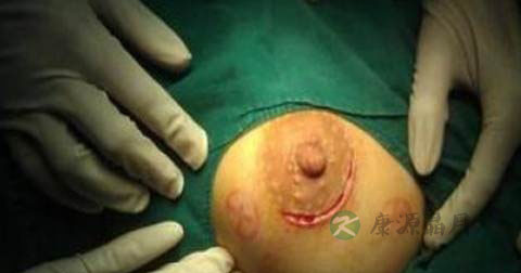 乳腺纤维瘤手术后注意事项