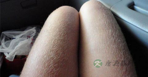 女人腿毛多怎么办？6招远离多毛症