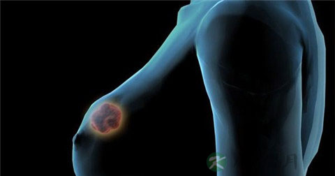 乳腺癌的高危人群