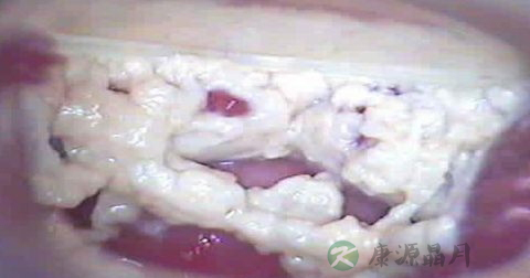 霉菌性阴道炎症状