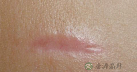 消除抓伤疤痕的方法_抓伤疤痕如何去除