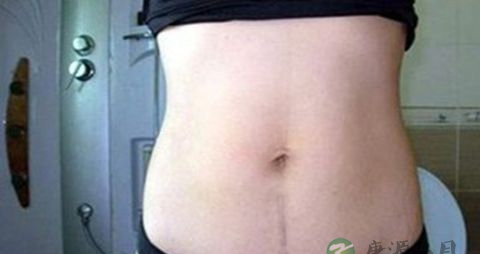 剖腹产后有什么后遗症