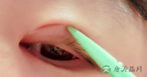 眼皮越来越厚重是什么病