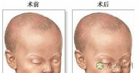 唇裂兔唇儿怎么喂养照顾